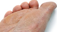 امراض القدم الجلدية
