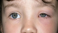 امراض العيون عند الاطفال