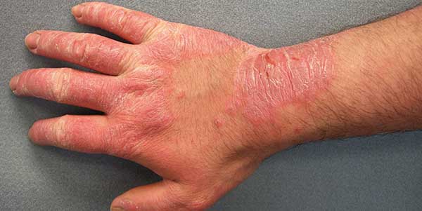 امراض الجلد الفيروسية