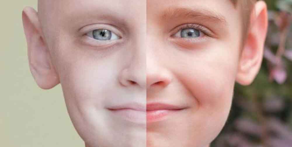 اعراض سرطان الدم عند الاطفال بالصور