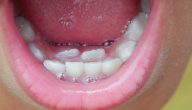 معلومات عن الاسنان اللبنية والدائمة