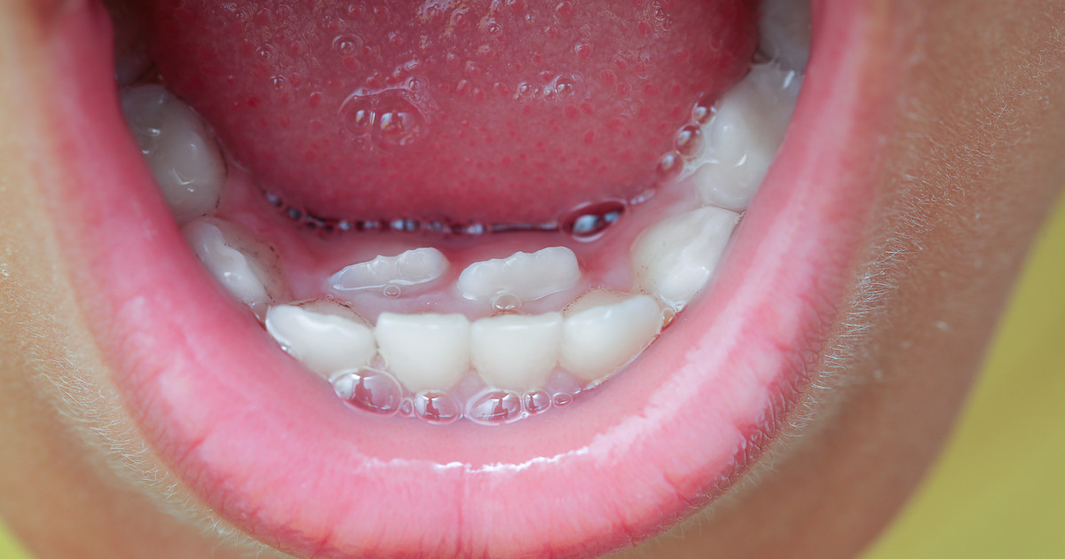 معلومات عن الاسنان اللبنية والدائمة