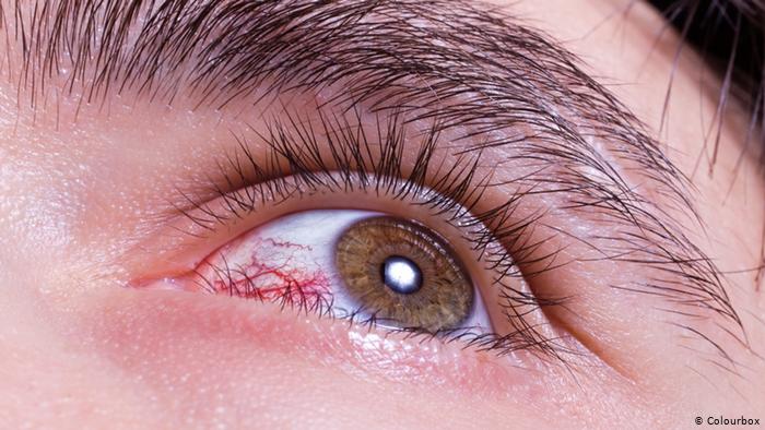 اخر علاج للعيون الوراثيه