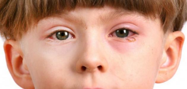 امراض العيون عند الاطفال بالصور