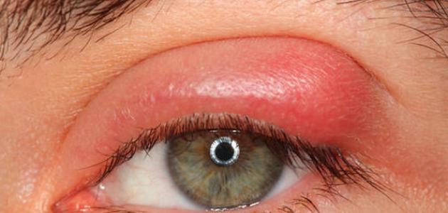 علاج امراض العيون