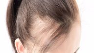 علاج تساقط الشعر الوراثي عند النساء