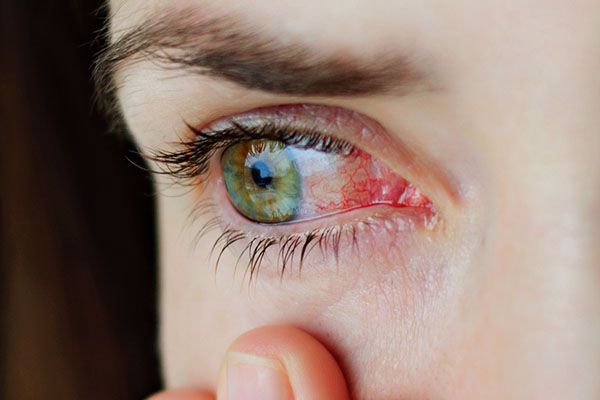 ما هو الالتهاب الفيروسي في العين