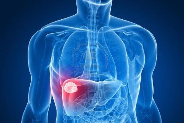 أعراض سرطان الكبد الحميد