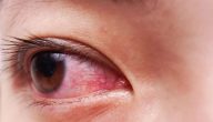 ما هو علاج التهاب العين بالاعشاب