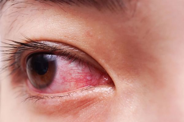 ما هو علاج التهاب العين بالاعشاب