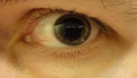 علاج ارتفاع ضغط العين المفاجئ