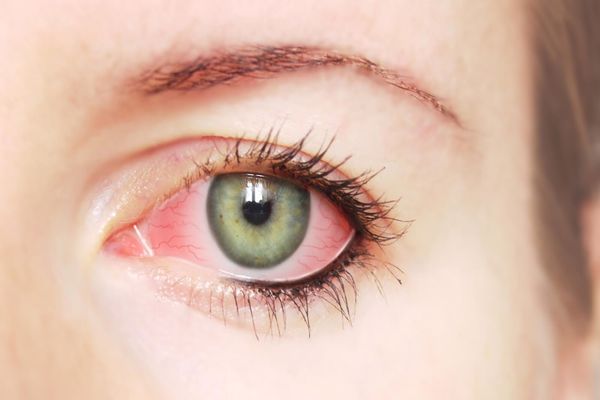 علاج التهاب واحمرار العين بالأعشاب