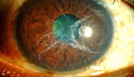 أمراض العيون الوراثية