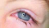 علاج التهاب العين الفيروسي في المنزل