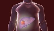 ما هو علاج الورم في الكبد
