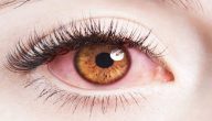علاج التهاب شبكية العين بالأعشاب