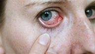 ما هو مرض الهربس في العين
