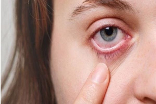 أنواع حساسية العين