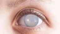 أمراض العين الماء الأبيض