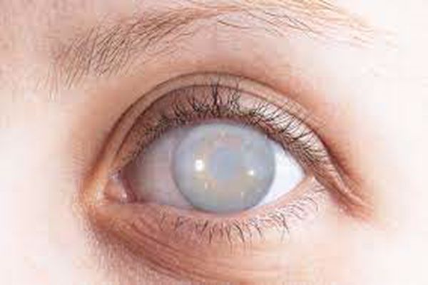 أمراض العين الماء الأبيض