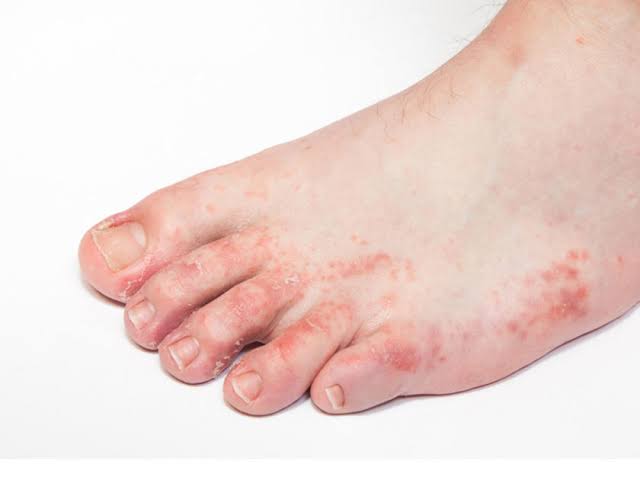 أعراض فطريات القدم