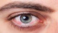 علاج ظهور نقطة حمراء في بياض العين عند الأطفال