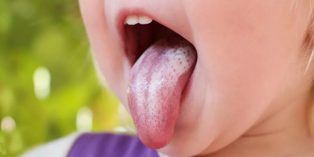 سبب فطريات الفم للكبار