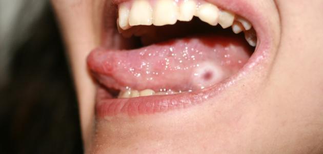 أنواع فطريات الفم