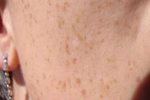 علاج فطريات الجلد البنية بالاعشاب