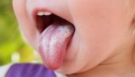 أسباب فطريات الفم عند الأطفال