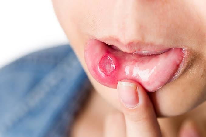 ما أسباب فطريات الفم