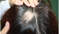 أعراض ثعلبة الشعر