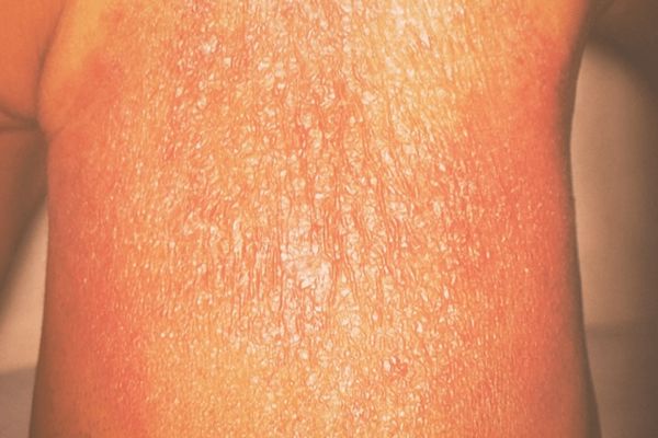 علاج الطفح الجلدي عند الكبار