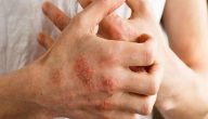 أعراض حساسية الدم على الجلد
