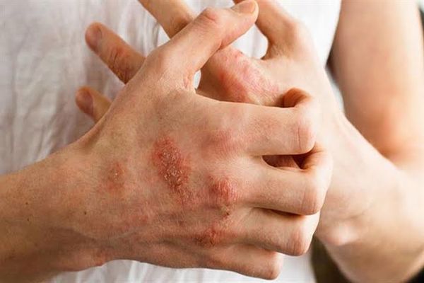 أعراض حساسية الدم على الجلد