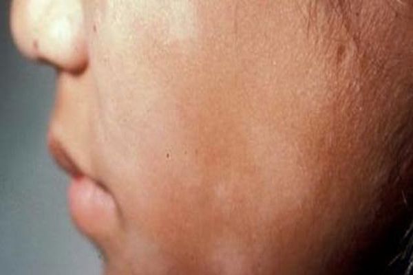 علاج الفطريات في الوجه بالاعشاب