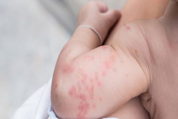 ما هو علاج الطفح الجلدي عند الاطفال