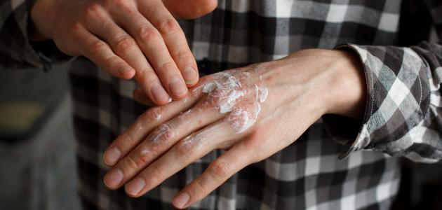 علاج أكزيما اليدين في المنزل