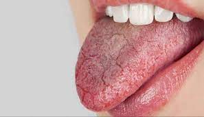 علاج جفاف الفم