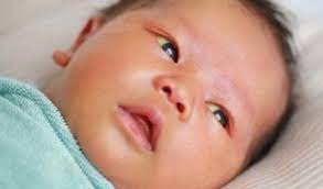 علامات الشفاء من اليرقان عند الرضع