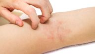 علاج حساسية الجلد والهرش للكبار